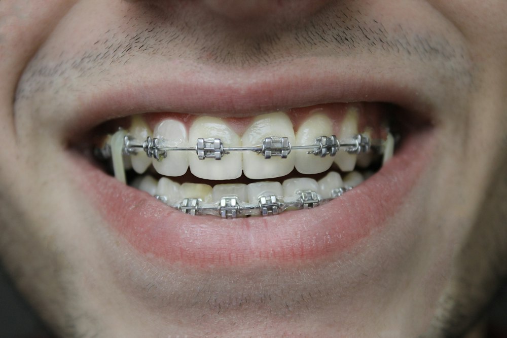 a smile with braces